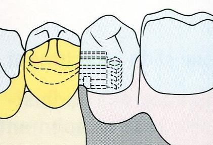 Ο βραχίονας αντιστήριξης είτε χυτεύεται σε ένα σώμα με τον μεταλλικό σκελετό, είτε χυτεύεται ξεχωριστά και ενσωματώνεται στο μεταλλικό σκελετό της μερικής οδοντοστοιχίας 2, 3, 7, με