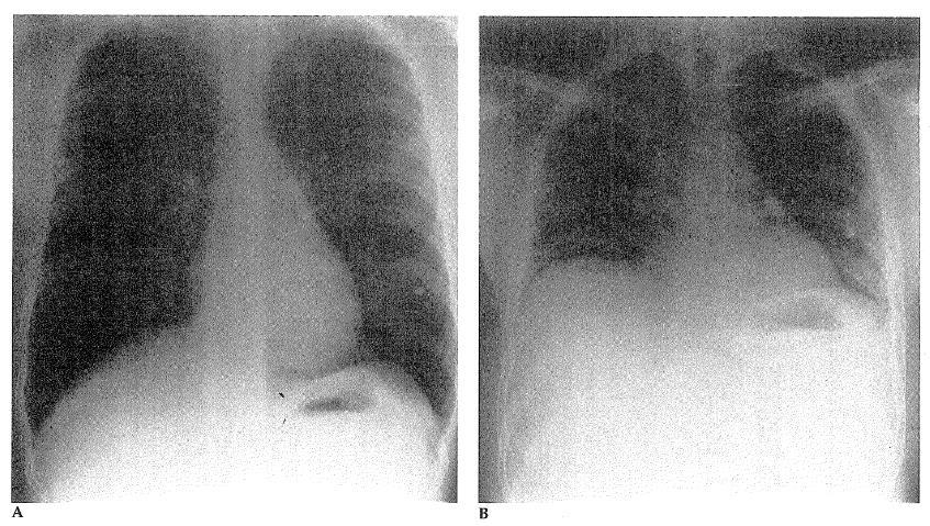 Το RV μπορεί εύκολα να μετρηθεί και να προστεθεί στο SVC, ώστε να προσδιοριστεί η ολική πνευμονική χωρητικότητα (Total Lung Capacity TLC), η οποία εκφράζεται ως ο όγκος του αέρα που περιέχεται στον