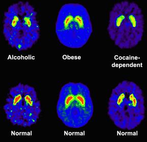 Εθισμός-φαρμακοεξάρτηση Το PET-scan δείχνει ότι οι παχύσαρκοι, αλκοολικοί και οι