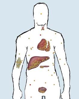 Συχνές βλάβες στα όργανα από εναποθέσεις σιδήρου στην καρδιά, το ήπαρ και τον αδενικό ιστό Αδένας της υπόφυσης Καχεκτική ανάπτυξη, στειρότητα Θυρεοειδής αδένας Υποδραστήριος Μυελός των οστών