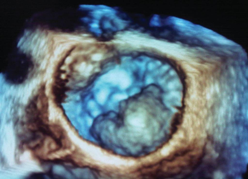 Degenerative mitral disease with large posterior leaflet prolapse imaged by real-time threedimensional transoesophageal echocardiography.