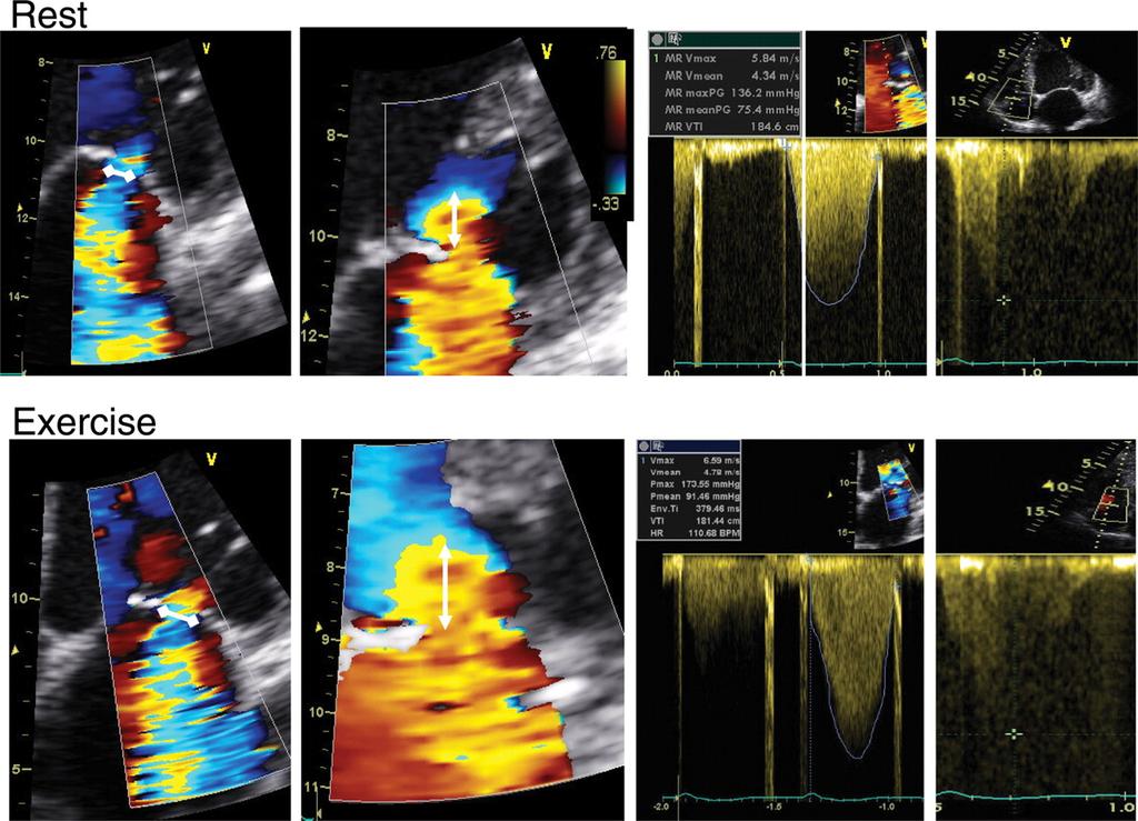 Large exercise-induced increase in ischaemic mitral regurgitation.