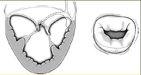 Functional MR Dilated Cardiomyopathy Disease of the left