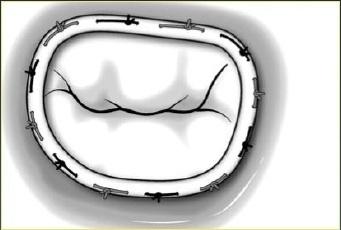 lateral distraction of the papillary muscles tethering the