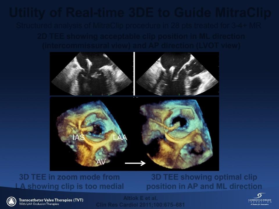 zoom mode from LA showing clip is too medial 3D TEE showing