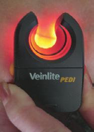 TransLite, LLC Veinlite Για Νήπια και Νεογνά Τέλος στις εικασίες - Τέλος στην αναζήτηση φλέβας Αποδεδειγμένη τεχνολογία Veinlite To Veinlite PEDI είναι η μικρότερη έκδοση της κλινικά αποδεδειγμένης