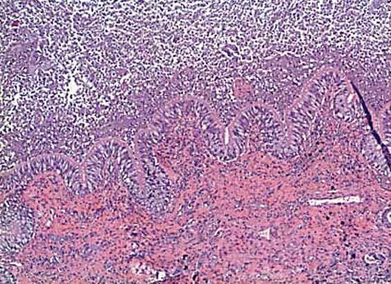 Bronchiectasis with chronically