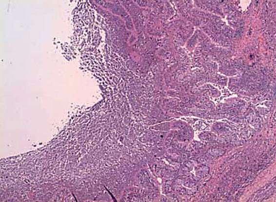 accompanying fibrosis J Rademacher