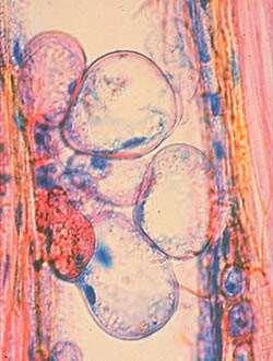 Τυλώσεις Ζωντανό πρωτόπλασμα παρεγχυματικών κυττάρων που εισέρχεται σε κοιλότητες μελών αγγείων Μεγεθύνεται και δημιουργεί τοιχώματα από μικροϊνίδια, όμοια με κυτταρικά με