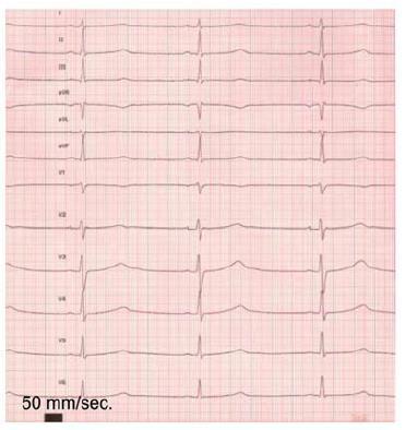 Long QT Brugada syndrome