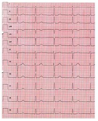 Catecholaminergic Polymorphous