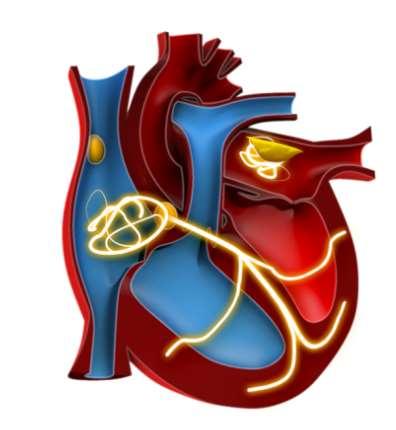 Current Treatment Strategies for AF Prevention of thrombo-embolism Rate