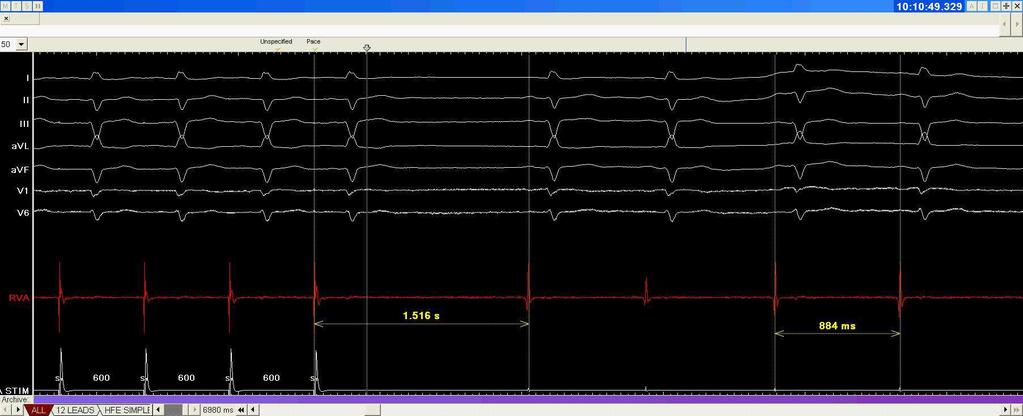 CSNRT (after atrial