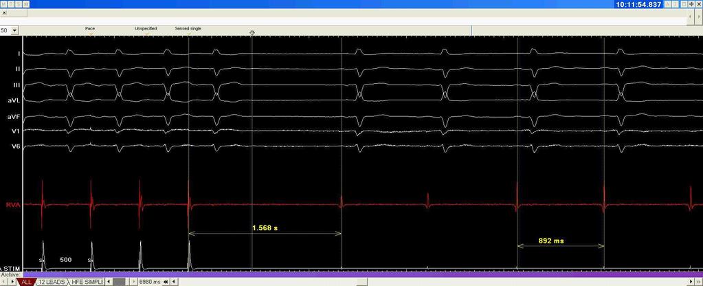 CSNRT (after atrial