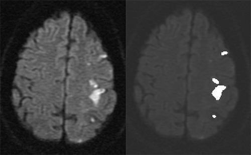 14 Εικόνα 7: Παράδειγμα εφαρμογής της κατάτμησης σε περιοχές σε εικόνα εγκεφάλου (αριστερά) και το αποτέλεσμα αυτής (δεξιά). Οι περιοχές ενδιαφέροντος φαίνονται με άσπρο χρώμα [34].