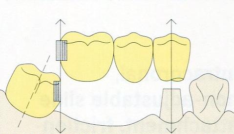 το άλλο δόντι στήριγμα κατά το τρόχισμα. Κατασκευάζεται στεφάνη στο δόντι στήριγμα που έχει την κλίση και τοποθετείται το βασικό τμήμα του συνδέσμου στην εγγύς επιφάνεια της στεφάνης.