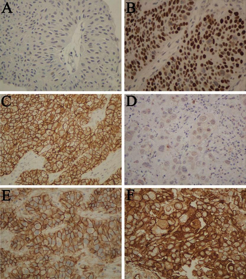 840 A. Athanasopoulou et al. / Urologic Oncology: Seminars and Original Investigations 31 (2013) 836 842 Fig. 2. Expression of p53, E-cadherin, and -catenin in urothelial bladder tumors.