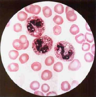 Κενοτόπια στο πρωτόπλασμα Neutrophil vacuolation, the presence of clear