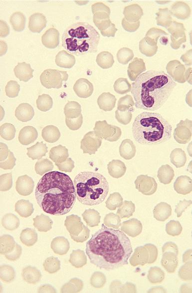 Μονοκυττάρωση Blood film showing monocytosis and neutrophilia in a patient with a bacterial infection.