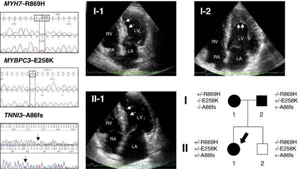 Τριπλές μεταλλάξεις στην υπερτροφική μυοκαρδιοπάθεια