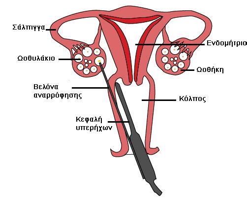 αριθμού των ωοθυλακίων που υπάρχουν διαθέσιμα στις ωοθήκες. γ) Γονιμοποίηση Ακολουθεί η λήψη και επεξεργασία του σπέρματος του συντρόφου το οποίο θα χρησιμοποιηθεί για τη γονιμοποίηση των ωαρίων.