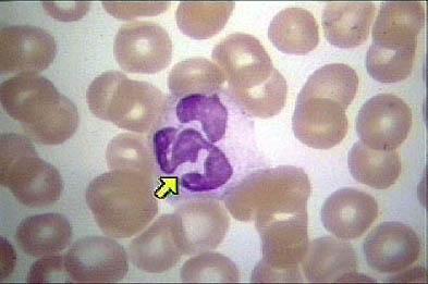 ουδετερόφιλα κοκκιοκύτταρα ή πολυμορφοπύρηνα (ΠΜΠ)