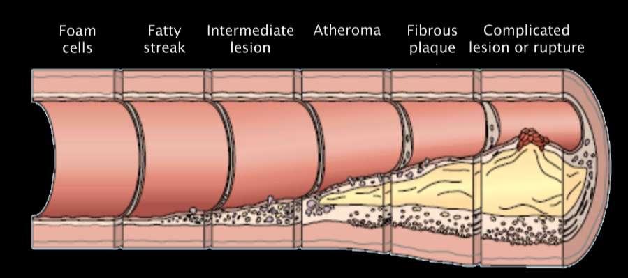 Η εξζλιξθ του ακθρϊματοσ [Grech 2003:A] Progression of coronary