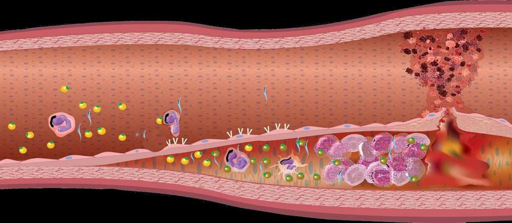 Η Αθηροσκλήρυνση Ξεκινά Νωρίς στη Ζωή και Εξελίσσεται Σιωπηρά για Πολλά Έτη Ρήξη πλάκας Μονοκύτταρο LDL-C Μόριο Μακροφάγο προσκόλλησης CRP Οξειδωμένη ΑφρώδεςLDL-C κύτταρο Λείες μυϊκές ίνες Από την 1