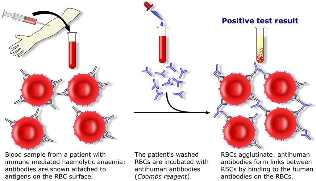 Άμεση Coombs Aνίχνευση Abs που βρίσκονται πάνω στα ερυθρά αιμοσφαίρια νεογνών με αιμολυτική νόσο ασθενών με αυτοάνοση αιμολυτική αναιμία ασθενών με αιμολυτική αναιμία από φάρμακα Ανίχνευση IgG Abs