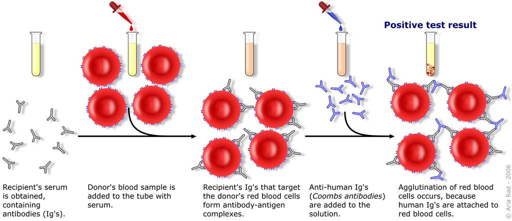 Έμμεση Coombs Ύπαρξη Abs έναντι των ερυθρών αιμοσφαιρίων στον ορό του αίματος γυναίκες Rhesus (-) που γέννησαν Rhesus (+) παιδί άτομα Rhesus (-) που έκαναν μετάγγιση Rhesus (+) αίματος Ανίχνευση