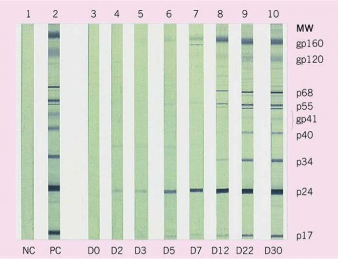 Ανοσοαποτύπωμα (Western Blot) Διάγνωση του Συνδρόμου Επίκτητης Ανοσολογικής Ανεπάρκειας (AIDS) Western blot analysis of HIV antigens and antibody.