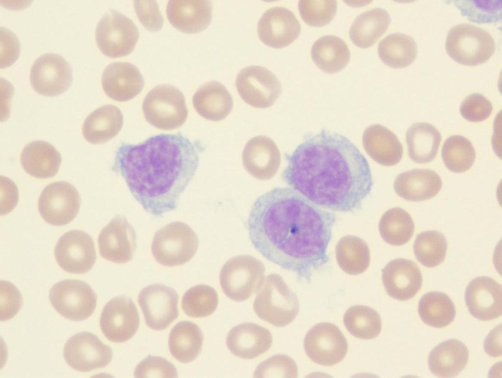 Λευχαιμία από τριχωτά κύτταρα (Hairy cell Leukemia - HCL) Χαρακτηριστικό λεμφοκύτταρο με προσεκβολές Β-λεμφοκύτταρο διαφορετικού