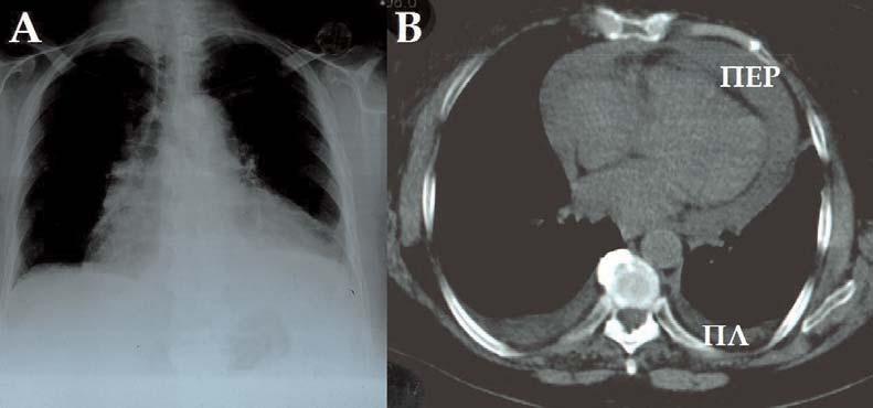 Εικόνα 1. Ακτινογραφία (Α) και αξονική τομογραφία (Β) θώρακος σε ασθενή με κυκλοτερή συλλογή (ΠΕΡ) και επιπωματισμό. ΠΛ=πλευριτική συλλογή.