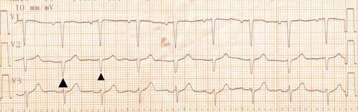 Εικονα 2. Ηλεκτρική εναλλαγή σε ασθενή με επιπωματισμό. Στην απαγωγή V2 τα δύο βέλη επισημαίνουν την διαφορά δυναμικού των συμπλεγμάτων QRS, καθώς και τις μεταβολές της μορφολογίας τους (απαγωγή V3).
