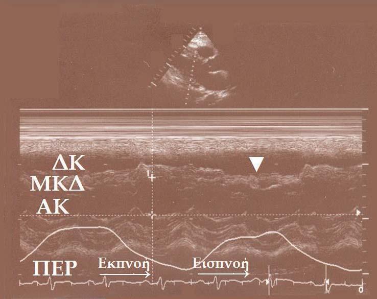 Η διαμετρικά αντίθετη συμπεριφορά των δύο κοιλιών σχετίζεται με το μηχανισμό του παράδοξου σφυγμού και συμβαίνει διότι κάθε αύξηση του όγκου της δεξιάς κοιλίας, όπως κατά την εισπνοή, συνοδεύεται από