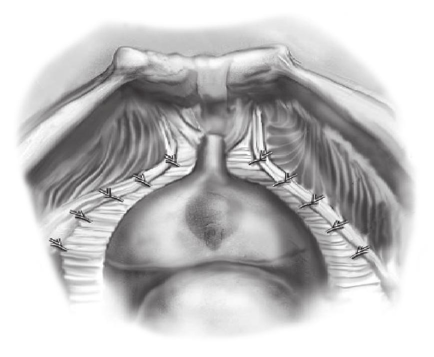 48 ΙΙΙ) Τοποθέτηση των δακτύλων του χειρουργού ή του βοηθού διαμέσου του κολπικού θόλου με σκοπό την ανύψωση του. ΙV) Παρασκευή και αναγνώριση του αυχένα της κύστης.