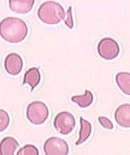 Thrombotic microangiopathies (TMAs) TMA = a syndrome There is not one TMA, but many forms of TMA Microangiopathic hemolytic anemia Peripheral thrombocytopenia Multiorgan failure