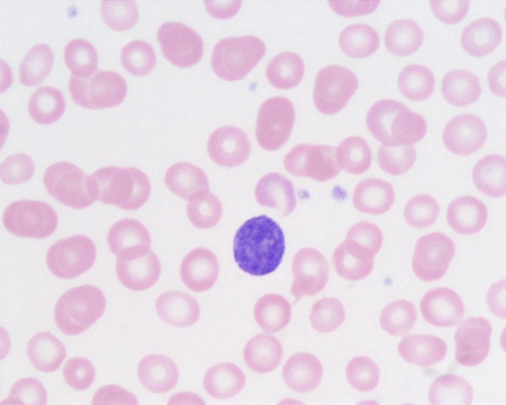 Είδη λευκοκυττάρων του πλάσματος 4/5 Λεμφοκύτταρα: Αποτελούνται από τα Β κύτταρα, τα Τ κύτταρα και τα