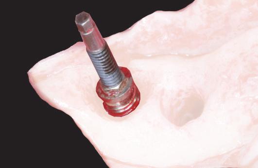 4 Εργαλείο αφαίρεσης οδοντικού εμφυτεύματος Σημείωση: Βιδώνει