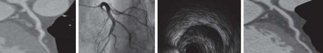 Several cases in the literature have shown that CT coronary angiography provides
