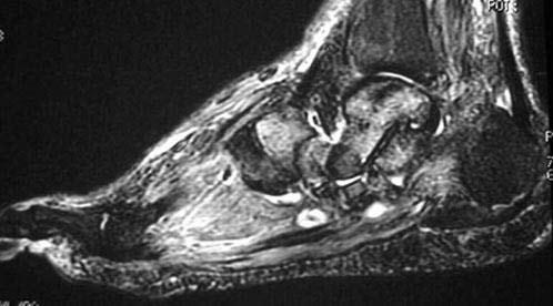 CHARCOT