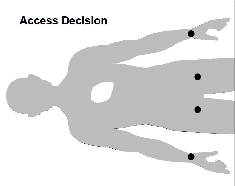 Αρτηριακή πρόσβαση Διπλή πρόσβαση 6F, 7F, 8F