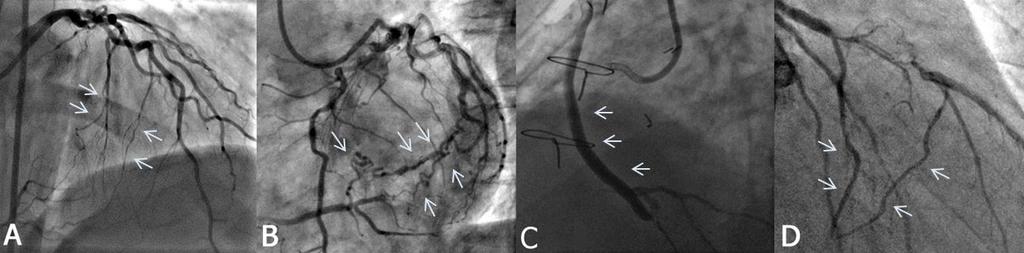 Classification of Collateral Connections Coronary Chronic Total Occlusion (CTO) retrograde filling of the Right Coronary Artery (RCA) via (A) septal collaterals (B)