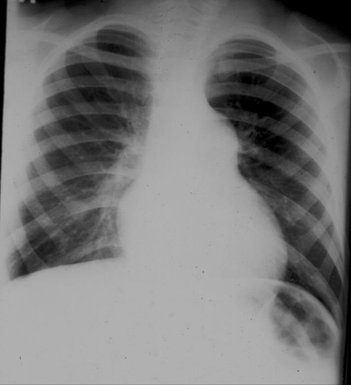 Στένωση πνευμονικής Απότομη διακοπή της πνευμονικής αρτηρίας αριστερά