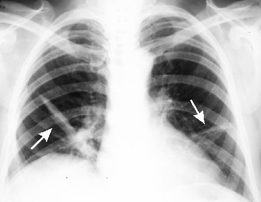 ΑΤΕΛΕΚΤΑΣΙΑ Η απώλεια όγκου ενός πνεύμονα ή λοβού