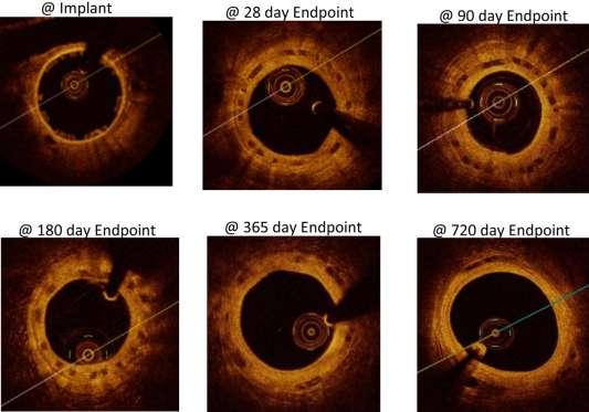 A Next-Generation Bioresorbable Coronary Scaffold System-From Bench to First Clinical Evaluation Six- and 12-Month Clinical and Multimodality Imaging Results QCA, IVUS and OCT at baseline and 6