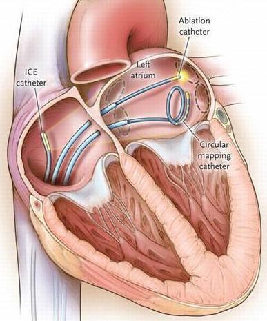 Ablation catheter: Καθετήρας κατάλυσης, Left atrium: Αριστερος κόλπος, Circular