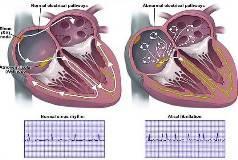 ΑΙΤΙΑ ΚΟΛΠΙΚΗΣ ΜΑΡΜΑΡΥΓΗΣ Καρδιακή ανεπάρκεια Στεφανιαία νόσος Αρτηριακή υπέρταση Βαλβιδοπάθειες- Μυοκαρδοπάθειες Υπερθυροειδισμός