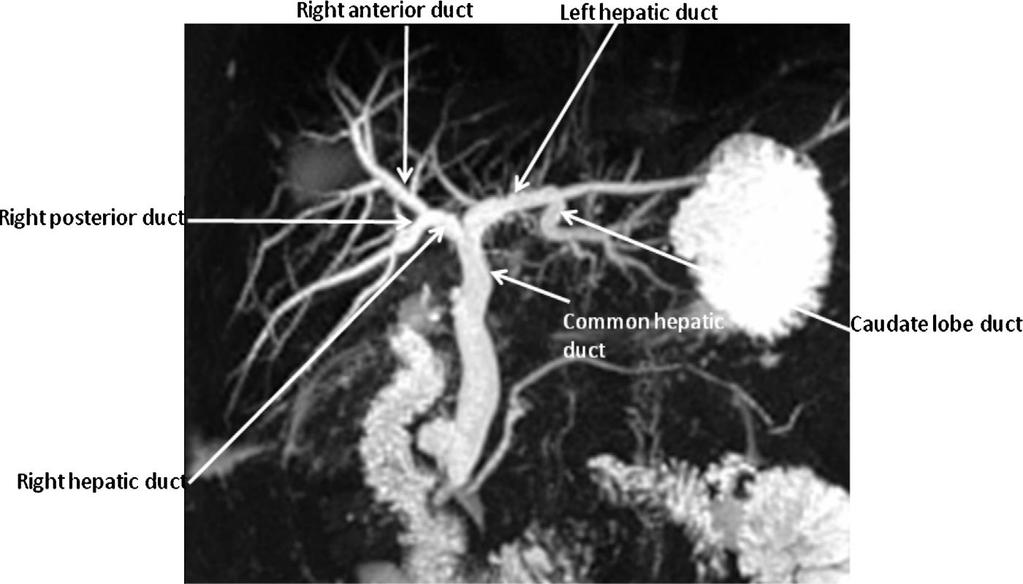 MRCP «Φυσιολογική» ανατομία (50-60%) Δεξιός