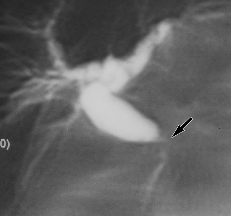 MRCP Διάταση